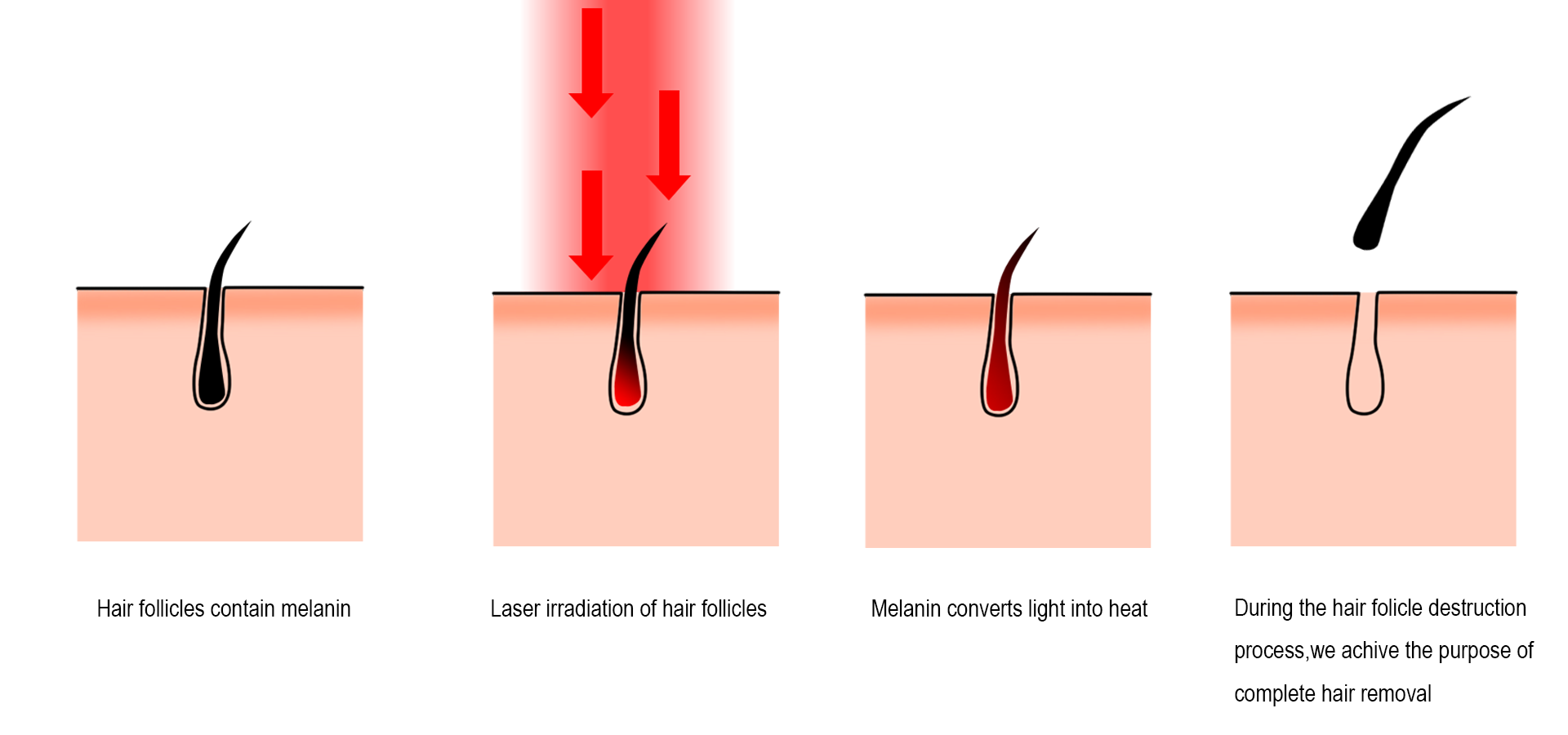 Progresso da depilação a laser - Como o laser remove os pelos com eficiência.